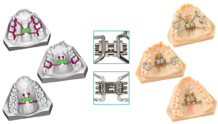 CAD-CAM Anatomical Expander