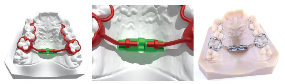 Micro Rapid CAD-CAM Expander
