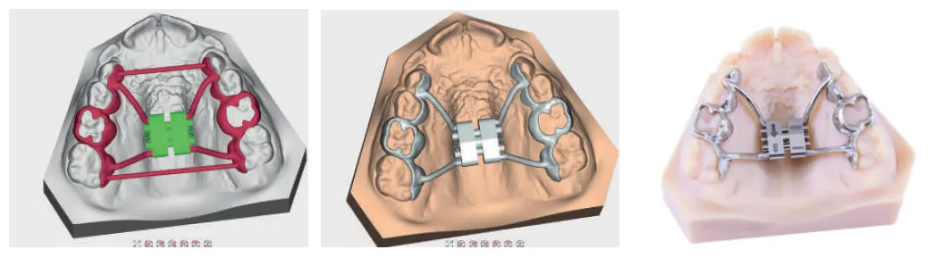 Rapid CAD-CAM Expander